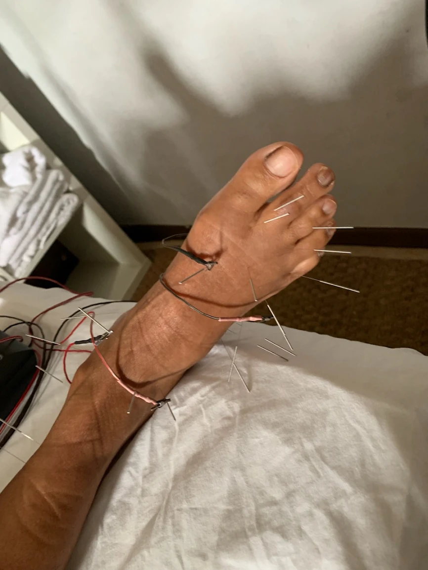 Acupuncture treatment for foot pain at Body & Healing Evolution